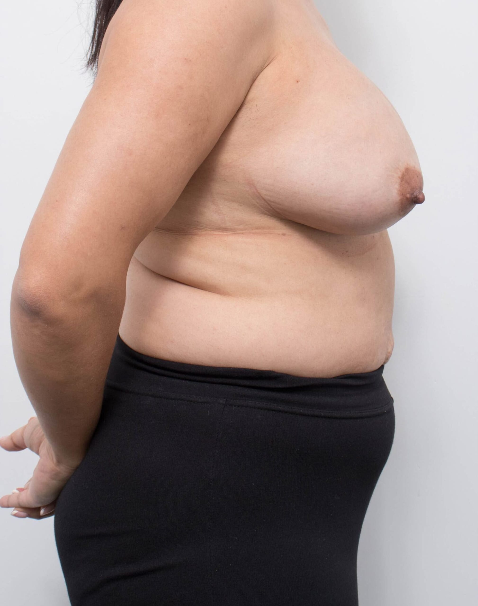 Before and after breast reduction surgery by Dr Eddie Cheng, AR Plastic Surgery Brisbane