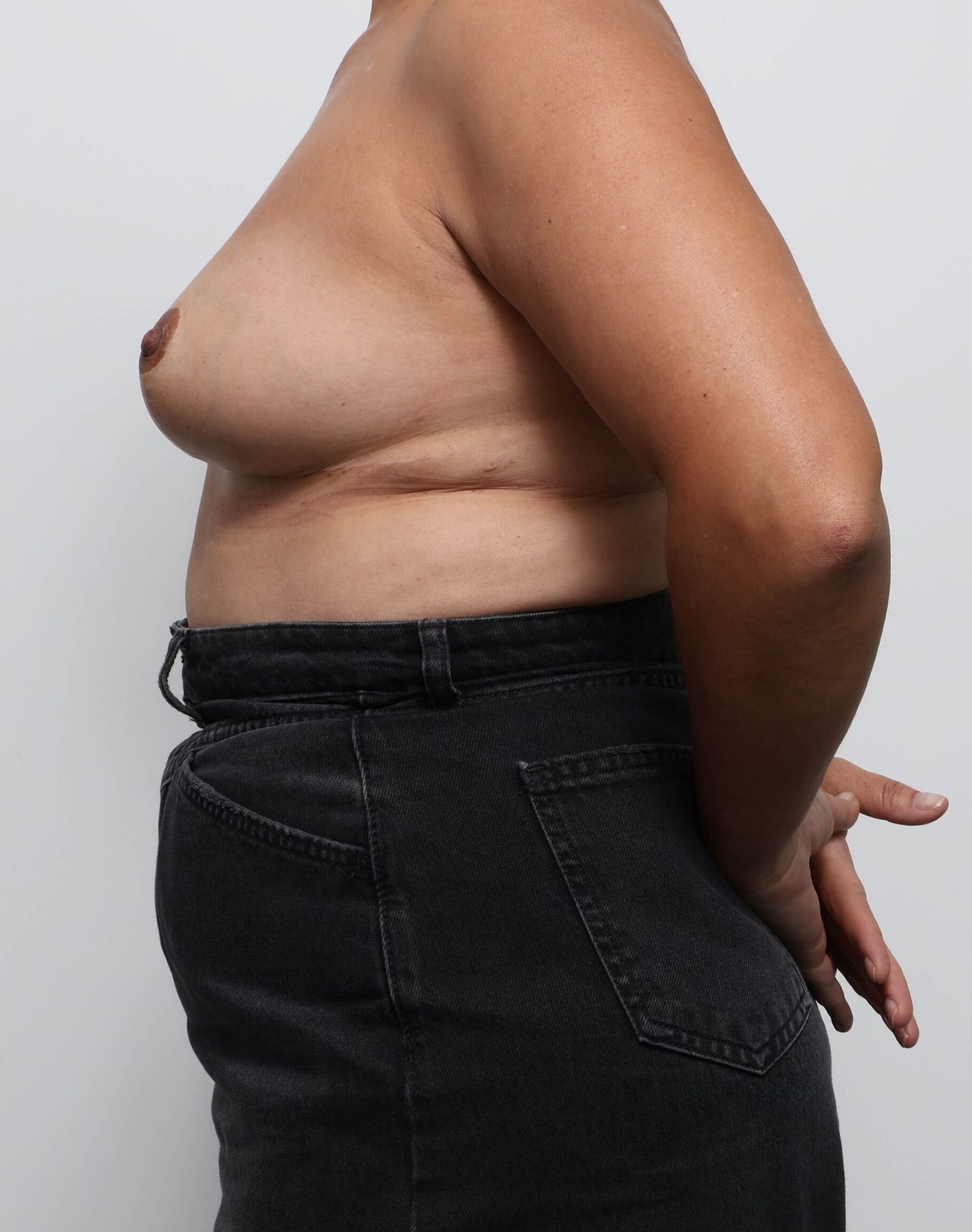 Before and after arm lift surgery by Dr Eddie Cheng, AR Plastic Surgery Brisbane