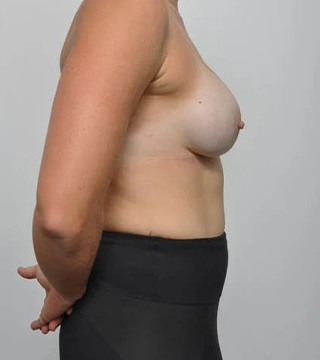 Before and after breast augmentation surgery by Dr Eddie Cheng, AR Plastic Surgery Brisbane