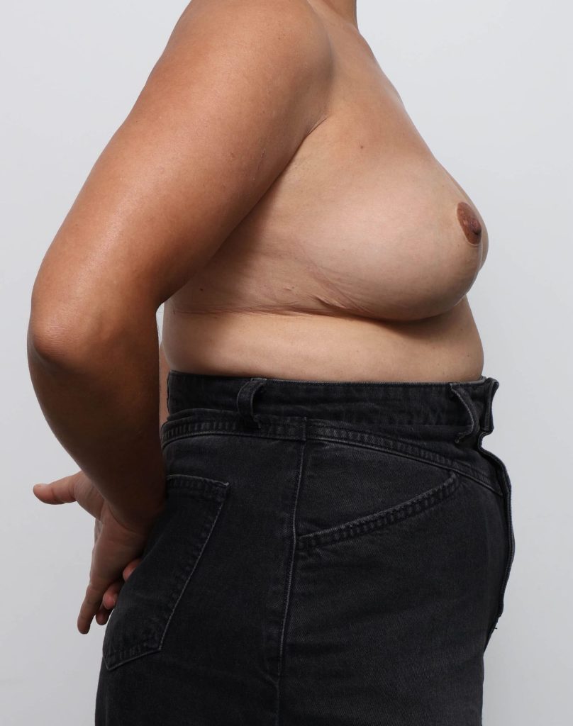 Before and after breast reduction surgery by Dr Eddie Cheng, AR Plastic Surgery Brisbane