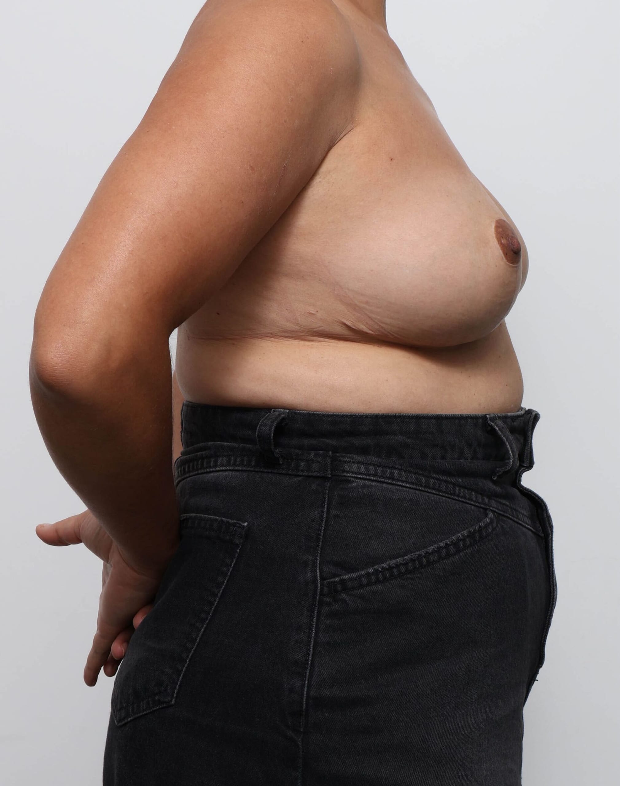 Before and after breast reduction surgery by Dr Eddie Cheng, AR Plastic Surgery Brisbane