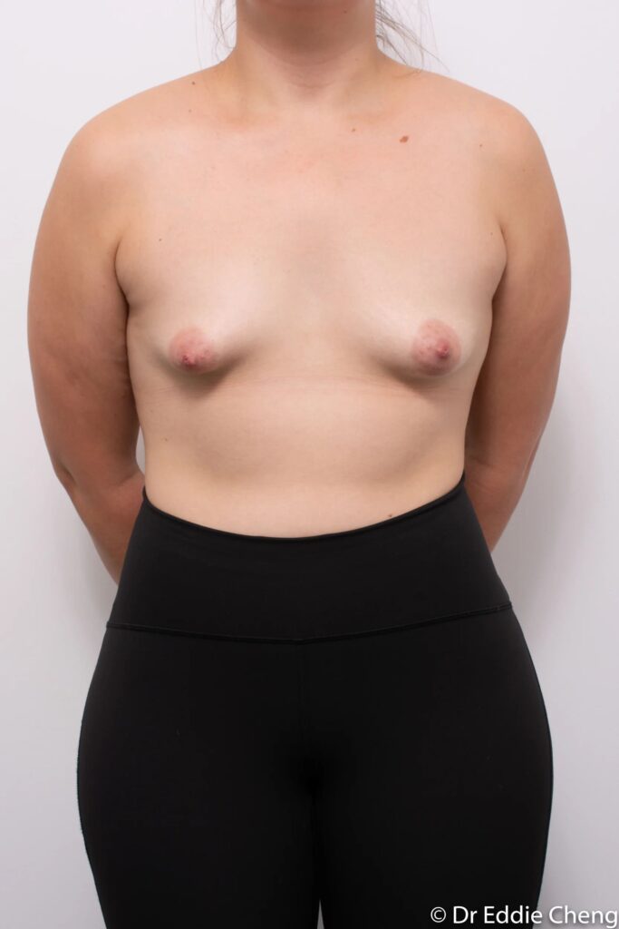 Before and after breast surgery by Dr Eddie Cheng, Brisbane