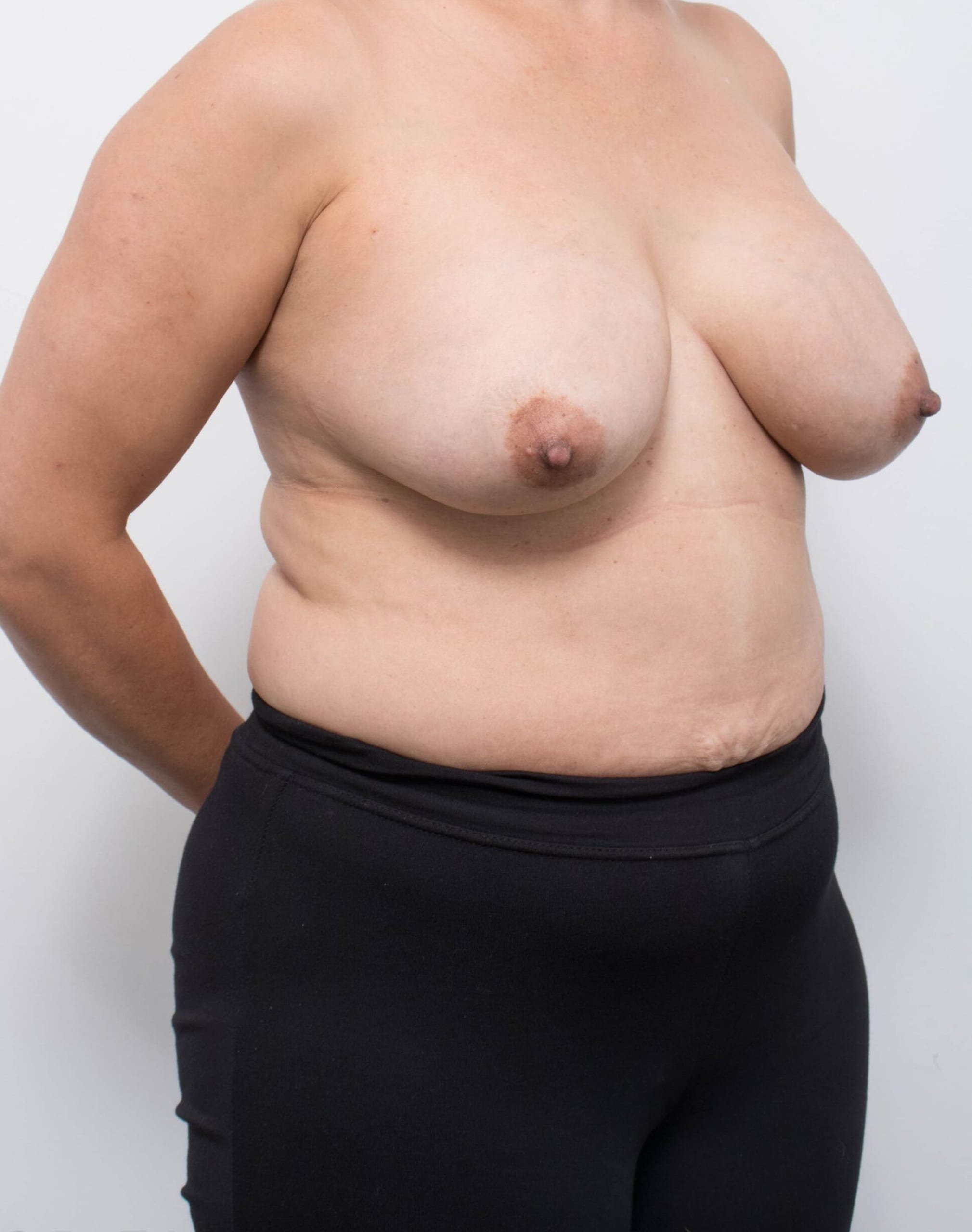Before and after breast reduction surgery by Dr Eddie Cheng, AR Plastic Surgery Brisbane