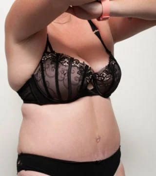 Before and after Surgery by Dr Eddie Cheng, Brisbane