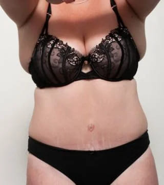 Before and after Surgery by Dr Eddie Cheng, Brisbane