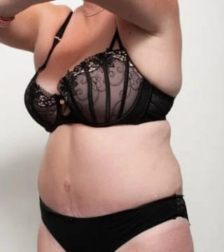 Before and after Surgery by Dr Eddie Cheng, Brisbane