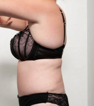 Before and after Surgery by Dr Eddie Cheng, Brisbane