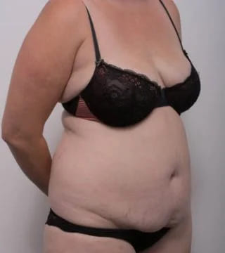 Before and after Surgery by Dr Eddie Cheng, Brisbane