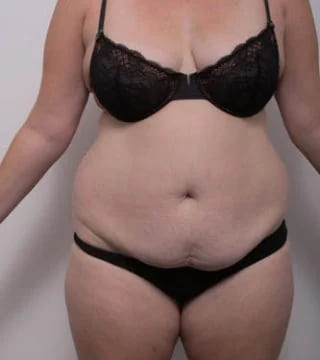 Before and after Surgery by Dr Eddie Cheng, Brisbane