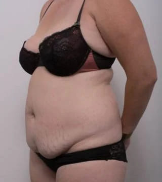 Before and after Surgery by Dr Eddie Cheng, Brisbane