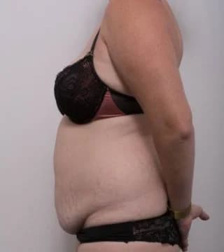 Before and after Surgery by Dr Eddie Cheng, Brisbane