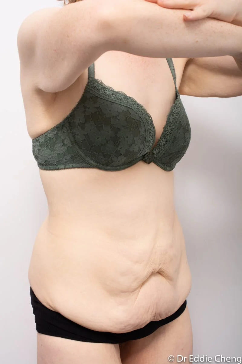 Before and after Abdominoplasty by Dr Eddie Cheng, Brisbane