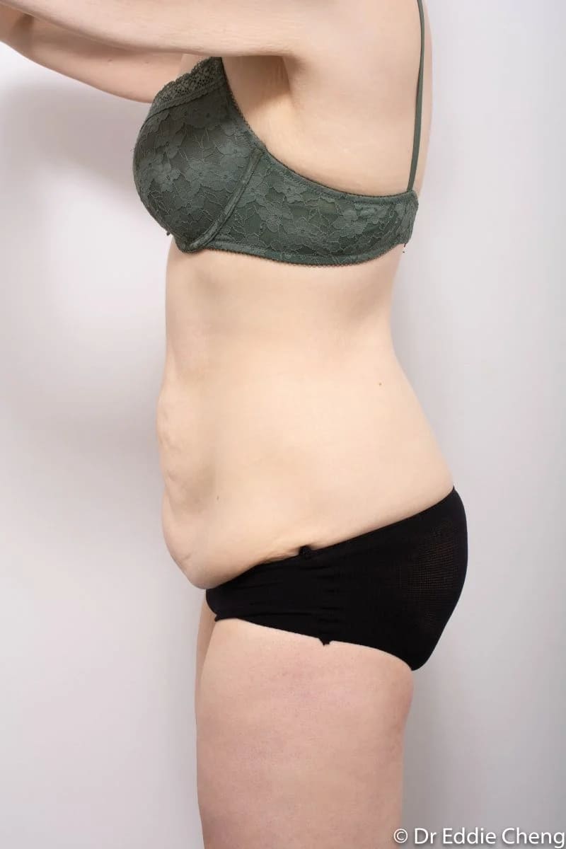Before and after Abdominoplasty by Dr Eddie Cheng, Brisbane