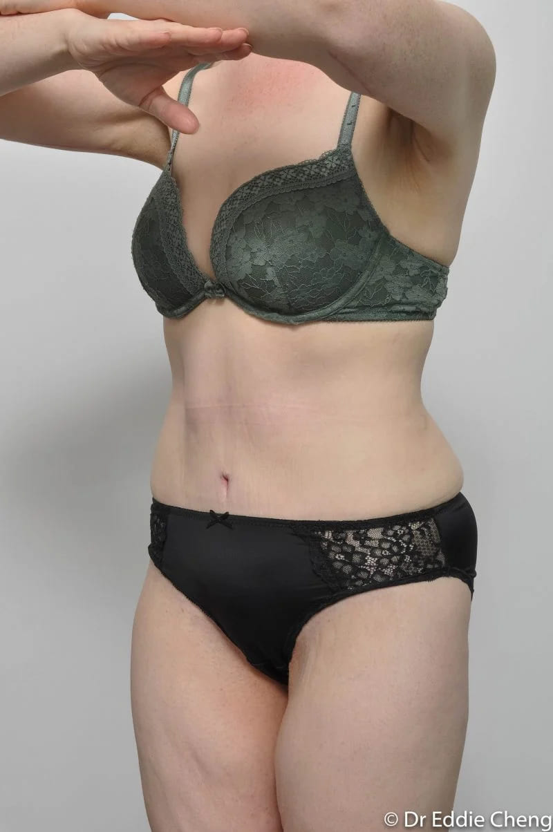 Before and after Abdominoplasty by Dr Eddie Cheng, Brisbane