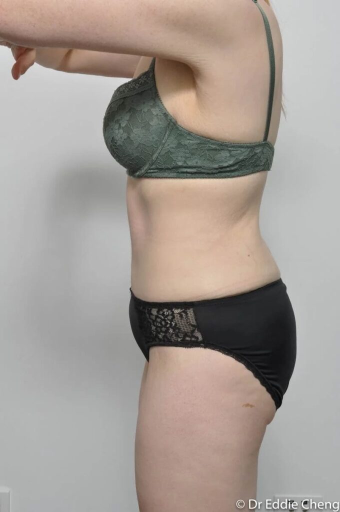 Before and after Abdominoplasty by Dr Eddie Cheng, Brisbane
