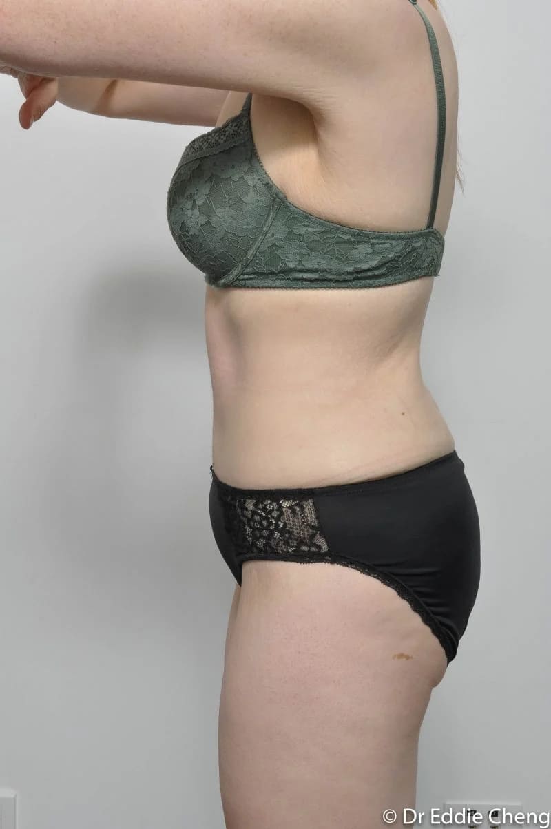 Before and after Abdominoplasty by Dr Eddie Cheng, Brisbane