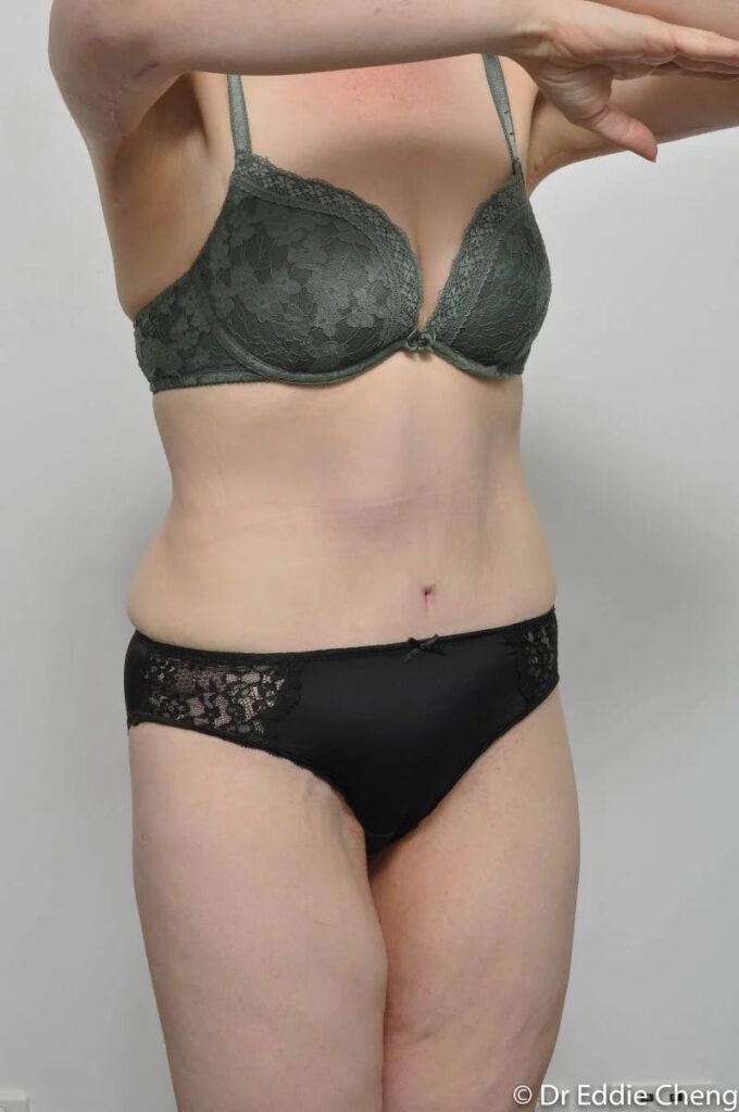 Before and after Abdominoplasty by Dr Eddie Cheng, Brisbane
