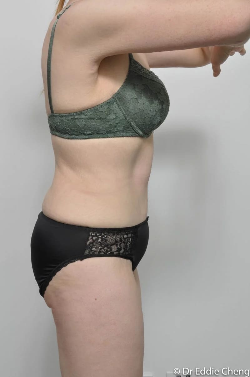 Before and after Abdominoplasty by Dr Eddie Cheng, Brisbane