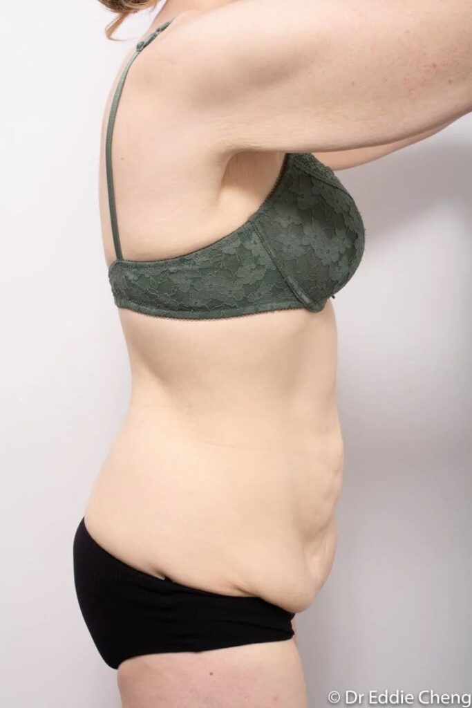 Before and after Abdominoplasty by Dr Eddie Cheng, Brisbane