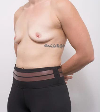 Before and after breast augmentation surgery by Dr Eddie Cheng, AR Plastic Surgery Brisbane
