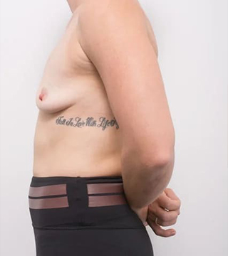 Before and after breast augmentation surgery by Dr Eddie Cheng, AR Plastic Surgery Brisbane