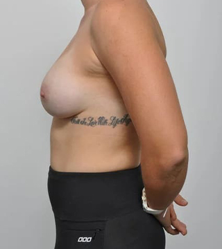 Before and after breast augmentation surgery by Dr Eddie Cheng, AR Plastic Surgery Brisbane