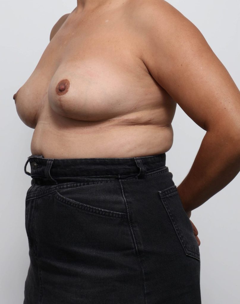 Before and after breast reduction surgery by Dr Eddie Cheng, AR Plastic Surgery Brisbane