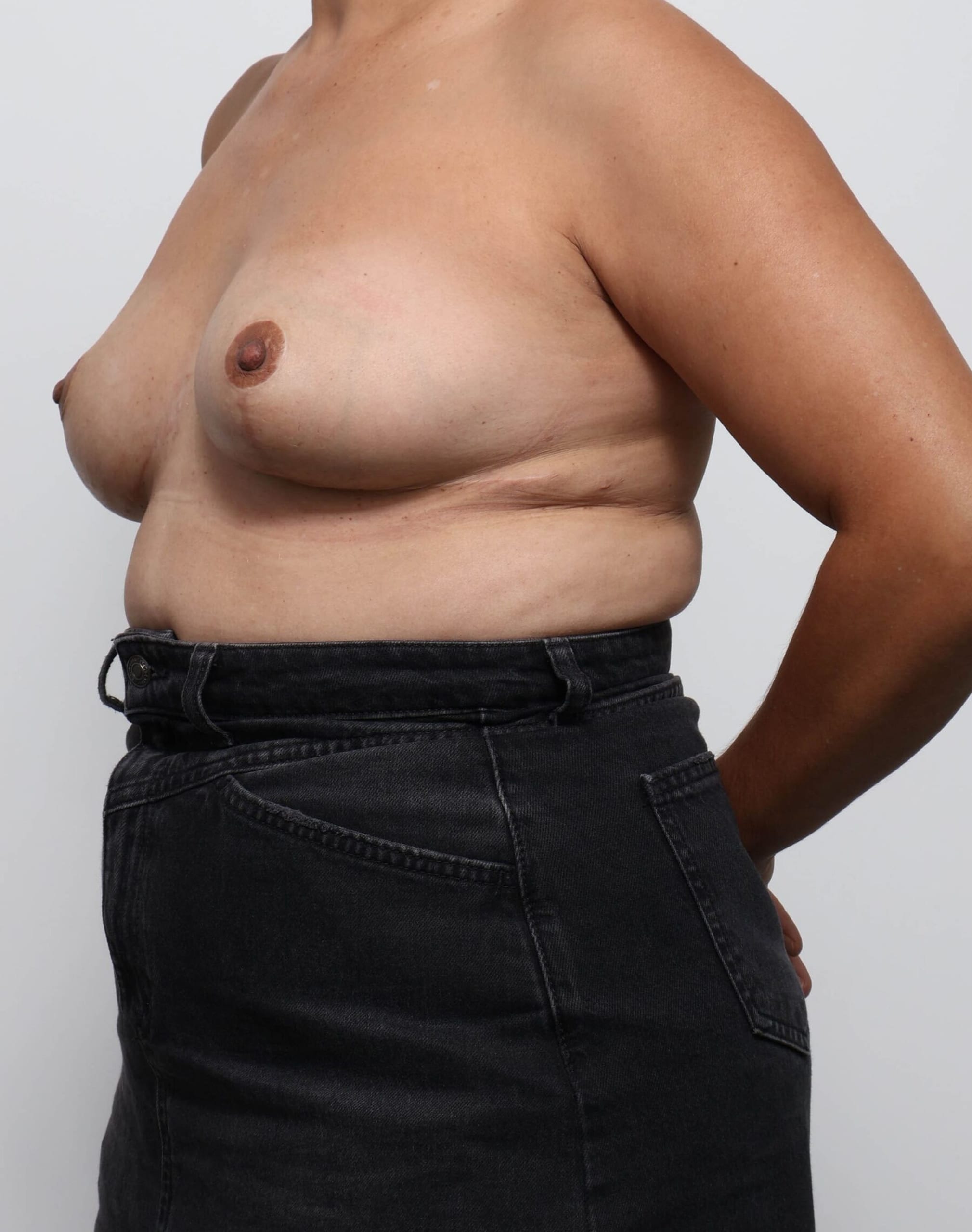 Before and after breast reduction surgery by Dr Eddie Cheng, AR Plastic Surgery Brisbane