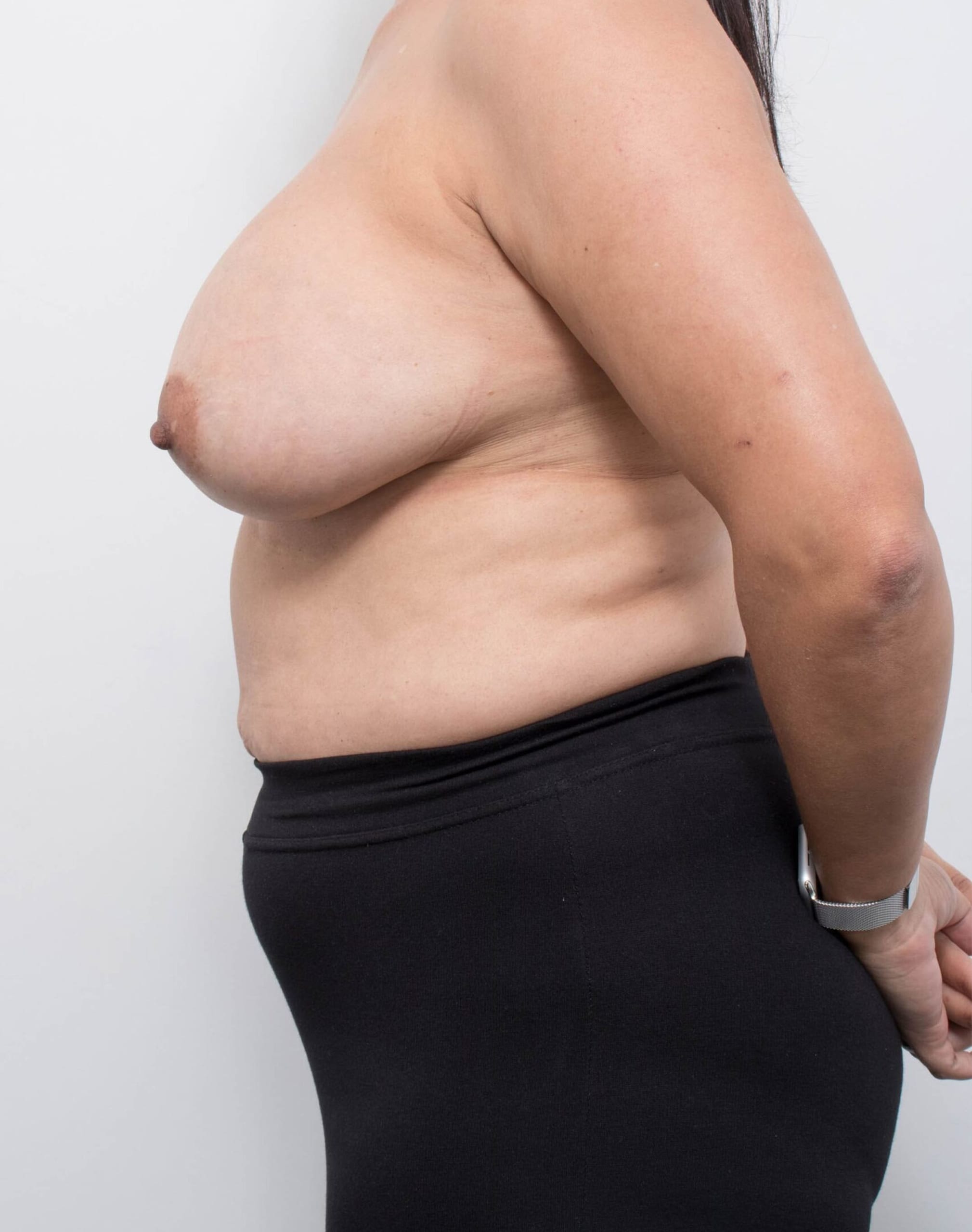 Before and after breast reduction surgery by Dr Eddie Cheng, AR Plastic Surgery Brisbane
