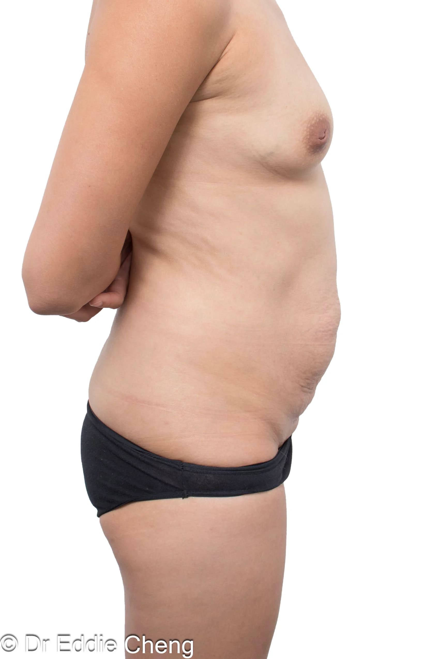 Before and after abdominoplasty by Dr Eddie Cheng, Brisbane