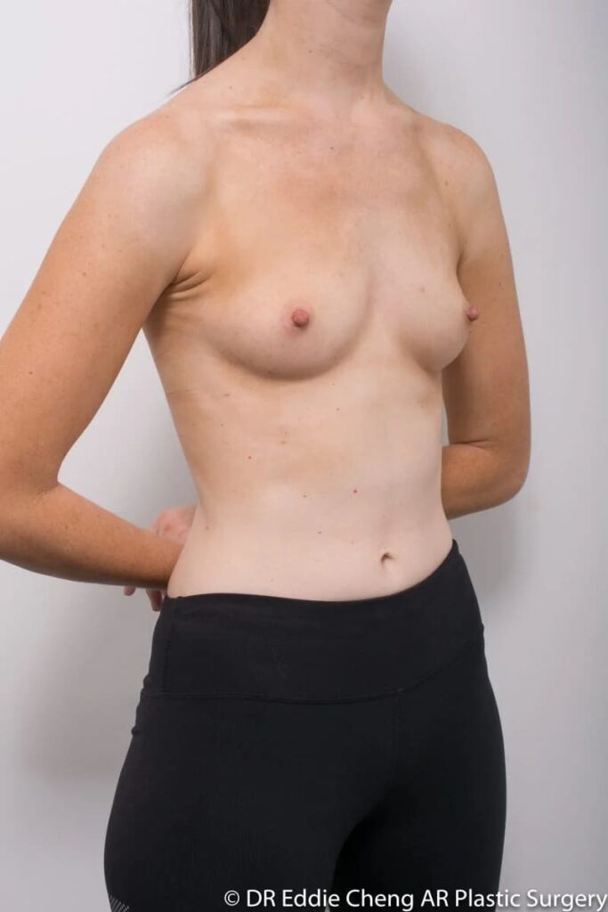 Before and after breast augmentation surgery by Dr Eddie Cheng, Brisbane