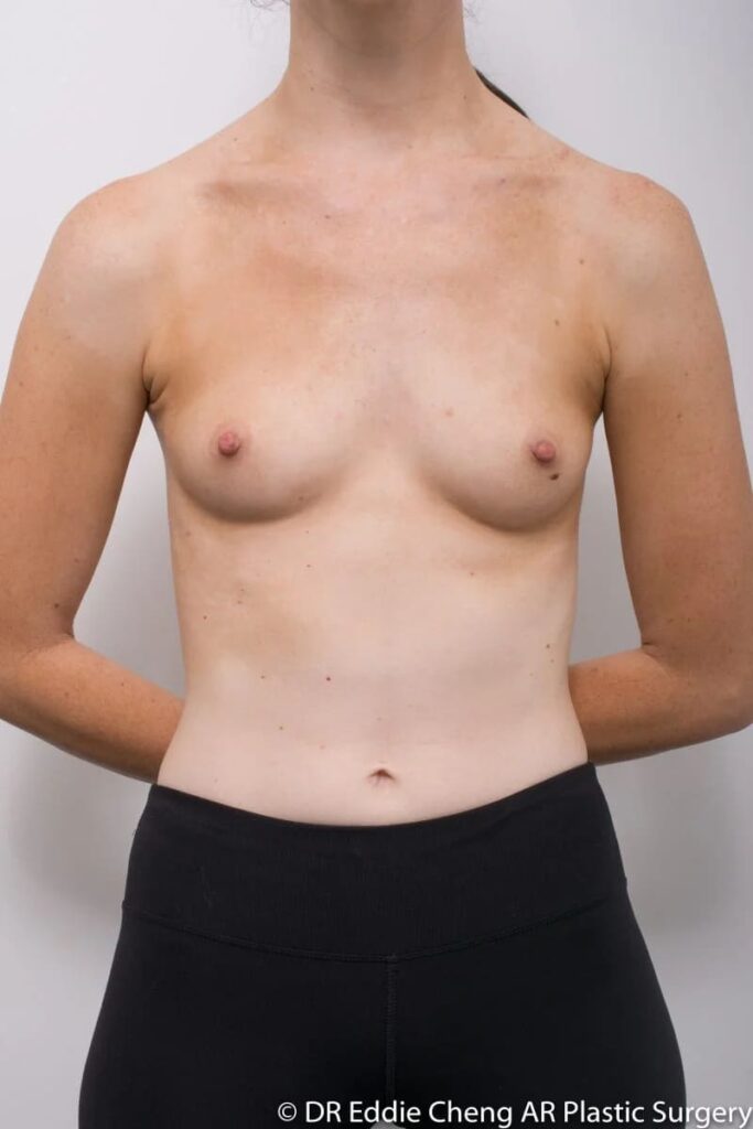 Before and after breast augmentation surgery by Dr Eddie Cheng, Brisbane