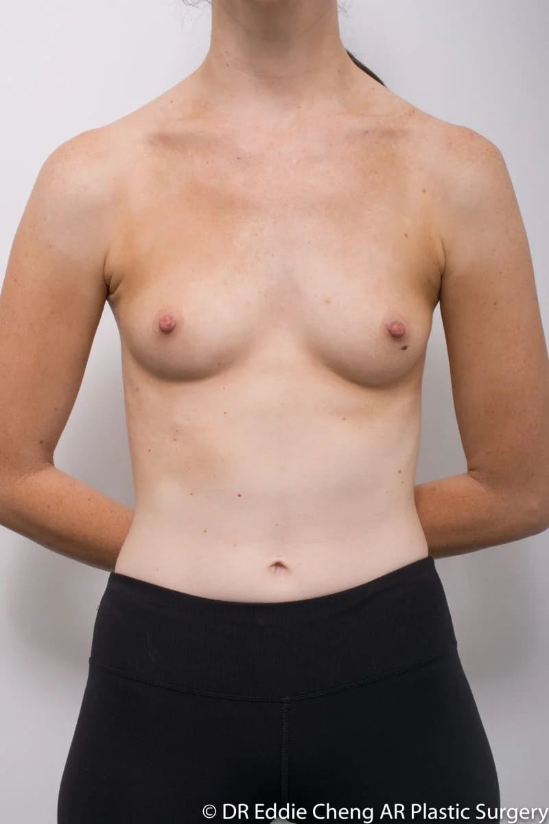 Before and after breast augmentation surgery by Dr Eddie Cheng, Brisbane