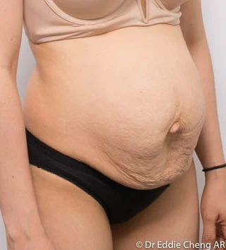 Before and after Abdominoplasty by Dr Eddie Cheng, Brisbane