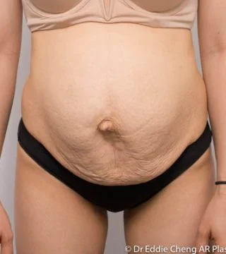 Before and after Abdominoplasty by Dr Eddie Cheng, Brisbane