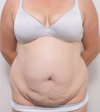 Before and after Abdominoplasty by Dr Eddie Cheng, Brisbane