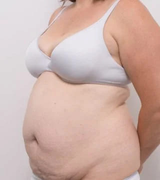 Before and after Abdominoplasty by Dr Eddie Cheng, Brisbane