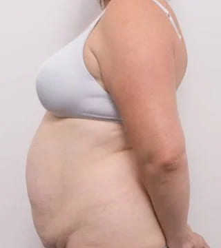 Before and after Abdominoplasty by Dr Eddie Cheng, Brisbane