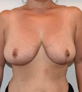 Before and after breast augmentation surgery by Dr Eddie Cheng, Brisbane
