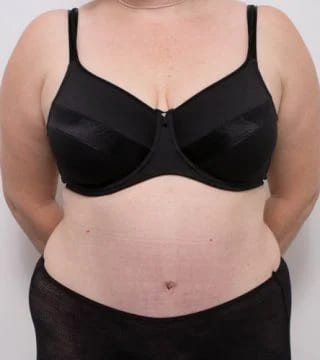 Before and after Abdominoplasty by Dr Eddie Cheng, Brisbane