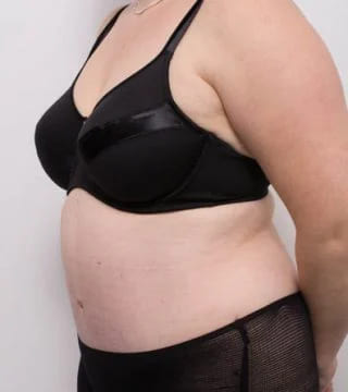 Before and after Abdominoplasty by Dr Eddie Cheng, Brisbane