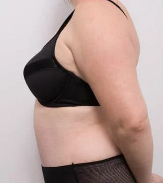 Before and after Abdominoplasty by Dr Eddie Cheng, Brisbane