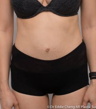 Before and after Abdominoplasty by Dr Eddie Cheng, Brisbane