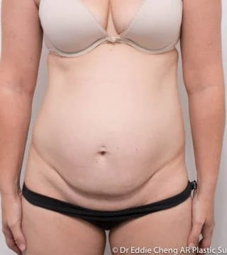 Before and after Abdominoplasty by Dr Eddie Cheng, Brisbane