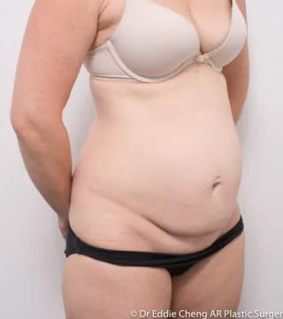 Before and after Abdominoplasty by Dr Eddie Cheng, Brisbane