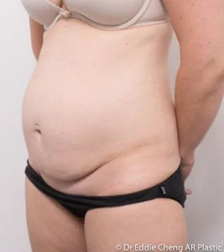 Before and after Abdominoplasty by Dr Eddie Cheng, Brisbane