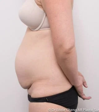 Before and after Abdominoplasty by Dr Eddie Cheng, Brisbane