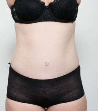 Before and after Abdominoplasty by Dr Eddie Cheng, Brisbane