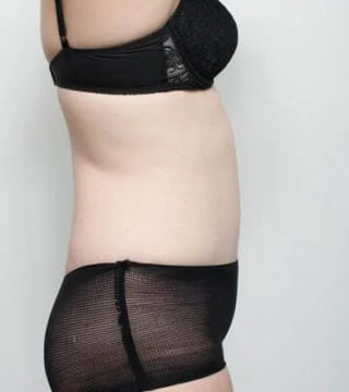 Before and after Abdominoplasty by Dr Eddie Cheng, Brisbane