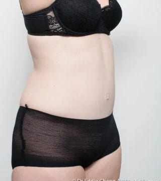 Before and after Abdominoplasty by Dr Eddie Cheng, Brisbane